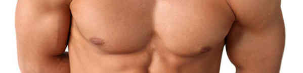 ginecomastia