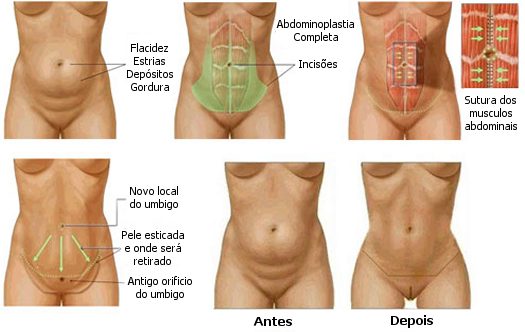 abdominoplastia fotos