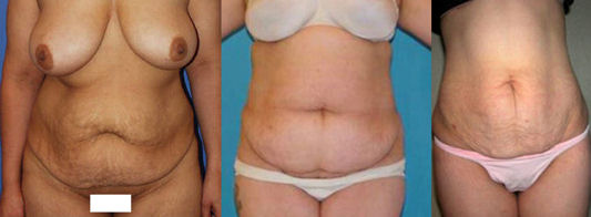 abdominoplastia