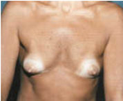 protese mamaria seios