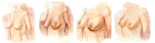 prótese mamaria