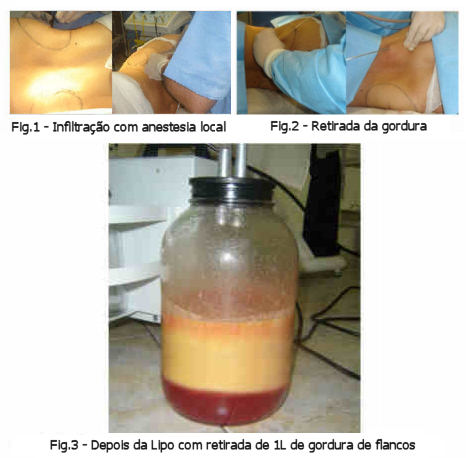 A lipoaspiracao ou lipo light é indicada para remoção de gordura localizada.