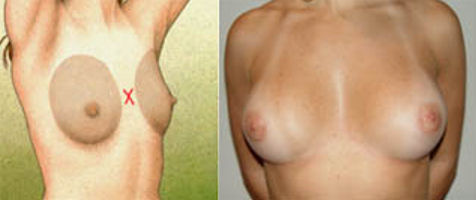 Protese mamaria